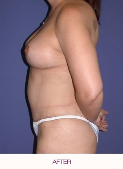 After full abdominoplasty and breast augmentation and lift