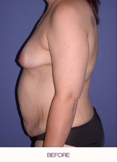Before full abdominoplasty and breast augmentation and lift