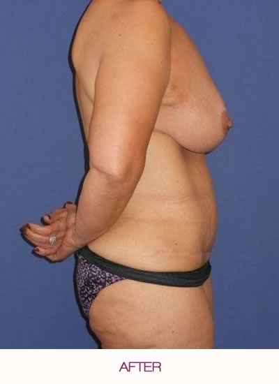 After abdominoplasty and breast reduction and lift.