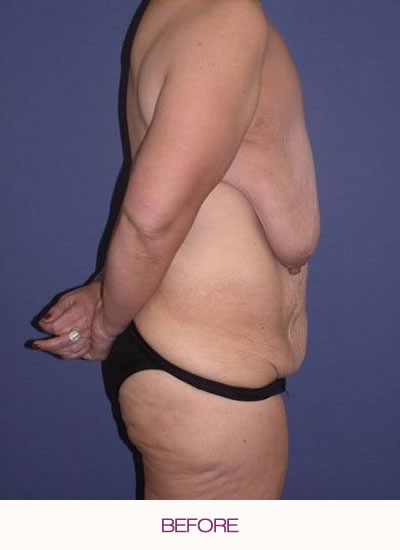 Before abdominoplasty and breast reduction and lift.