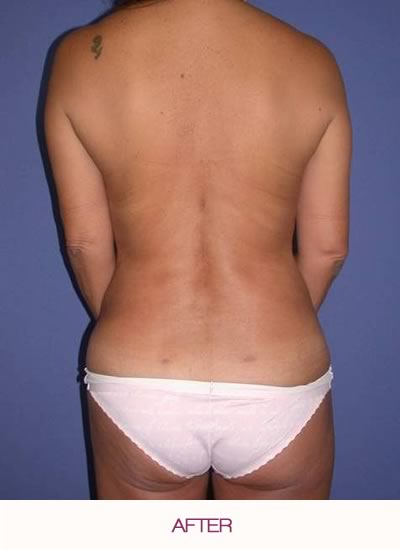 After abdominal liposuction and breast augmentation.