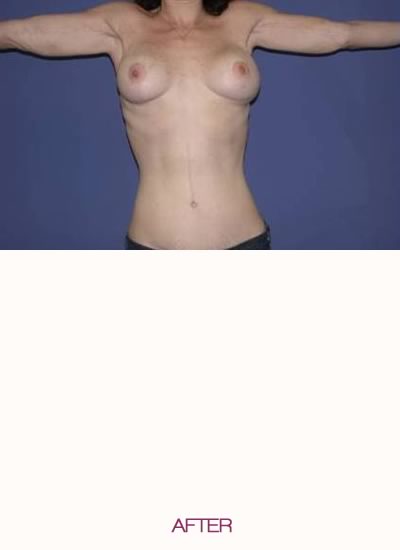 After full abdominoplasty, breast augmentation and lift, and arm lift.