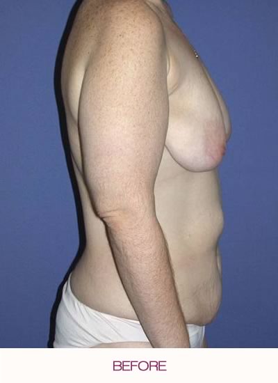 Before full abdominoplasty, breast augmentation and lift, and arm lift.