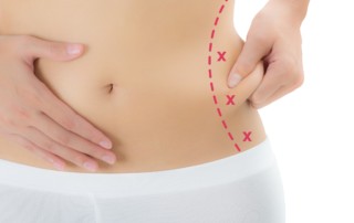 Tummy Tuck