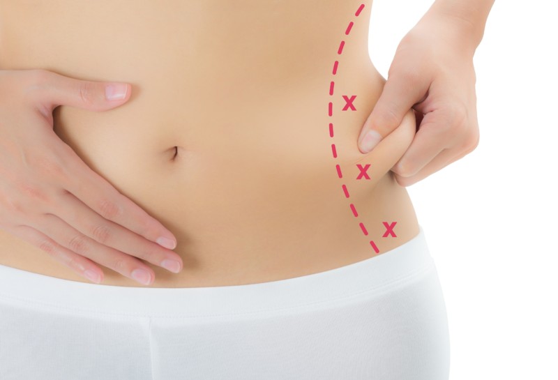 Tummy Tuck