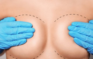 Lollipop breast lift