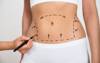 tummy tuck