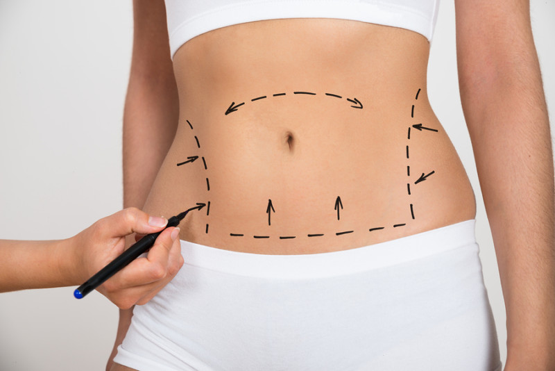 tummy tuck