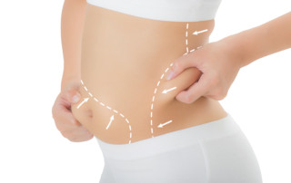 tummy tuck scar