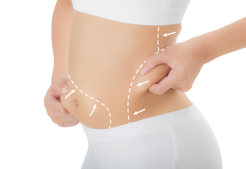 tummy tuck scar