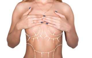 breast augmentation