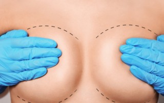 Breast reduction Miami