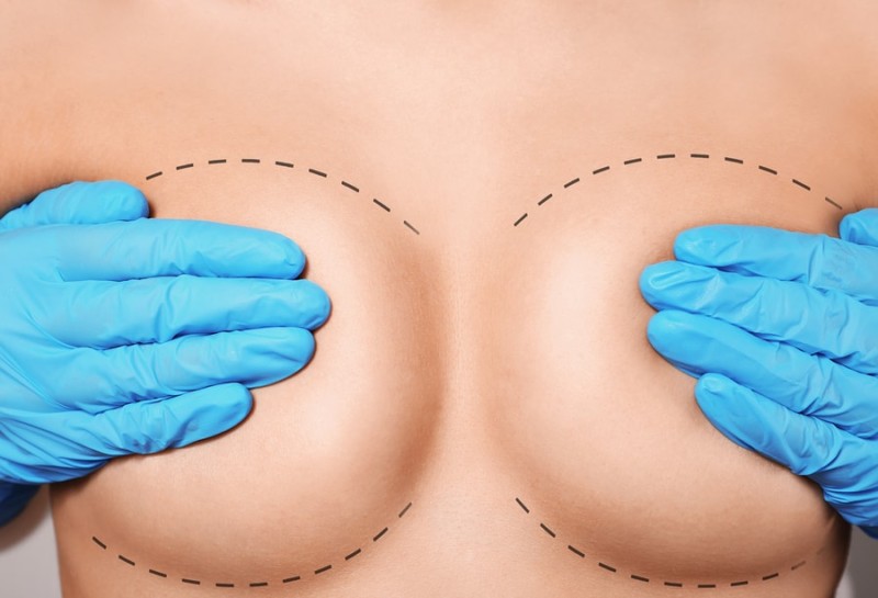 Breast reduction Miami